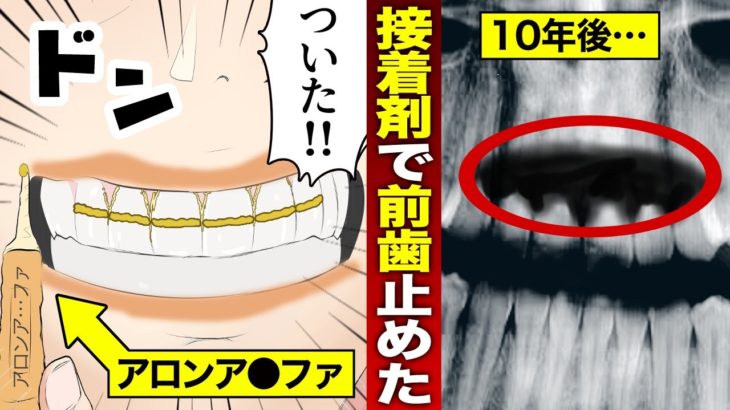 【実話】歯医者に行かず10年間瞬間接着剤で前歯を接着し続けるとどうなるのか？（マンガ動画）